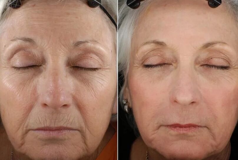 Results of fraction rejuvenation