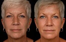 Woman's face before and after