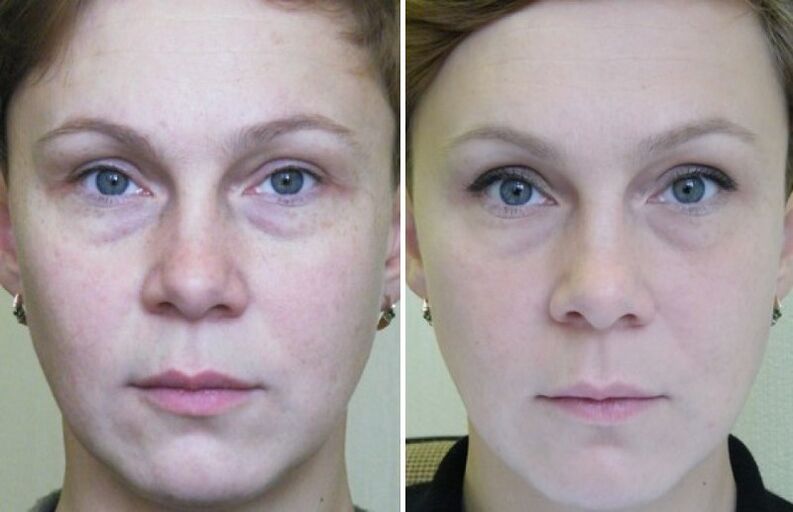 Before and after images of laser skin rejuvenation